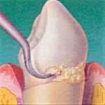 Tartar of the dental kind, image taken from Colgate's UK website, hosting by Photobucket